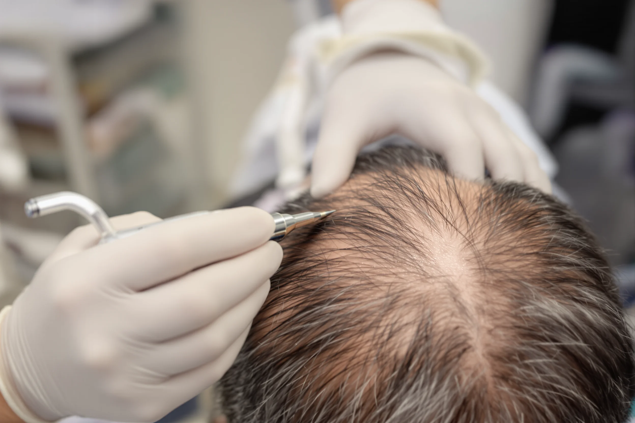 Trapianto di capelli DHI: il processo spiegato