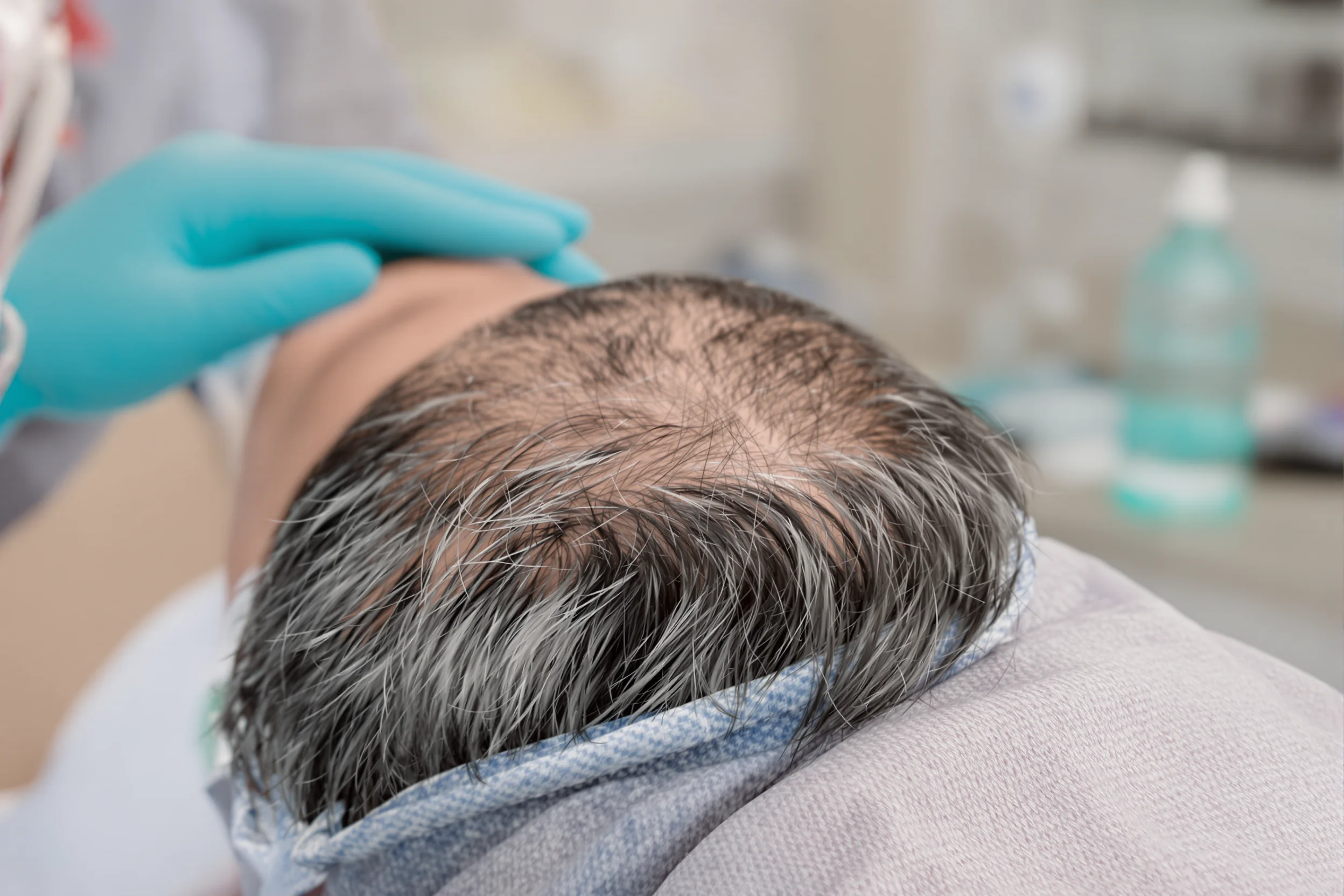 Trapianto di Capelli in Albania: Costi FUE, DHI e Sapphire FUE
