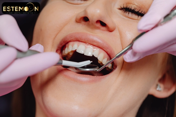 type of Procedures hollywood smile in istanbul