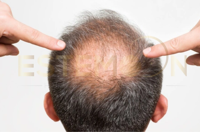 prevent hair loss men