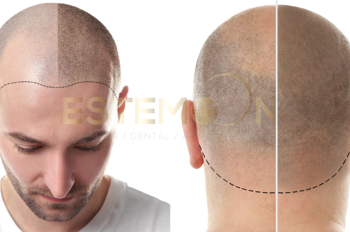Long-term-effects-of-hair-tattooing