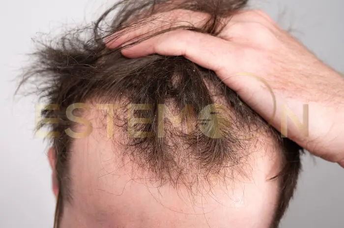 Which Vitamin Deficiency Causes Hair Loss