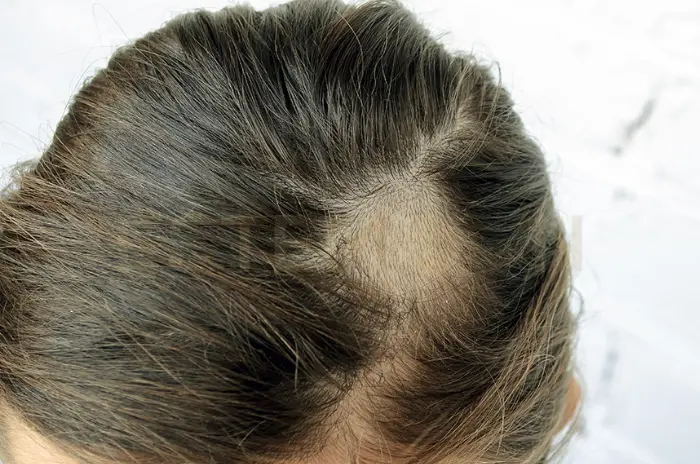 Ringworm in hair symptoms treatment and regrowth plan