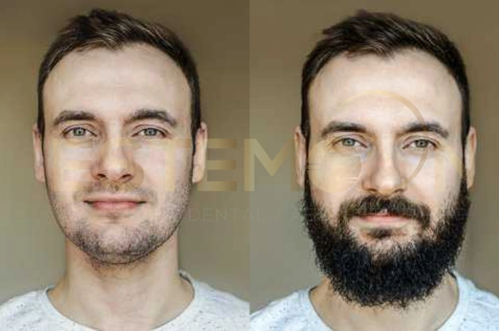 Topical minoxidil