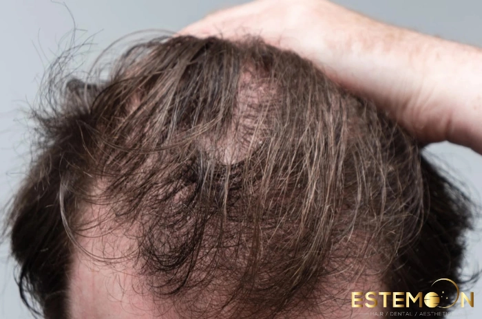 Ideal Candidates for neograft hair transplant
