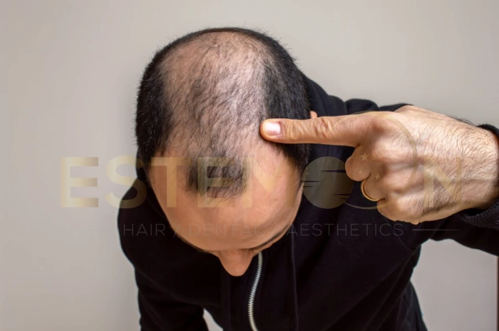 alcohol and hair loss