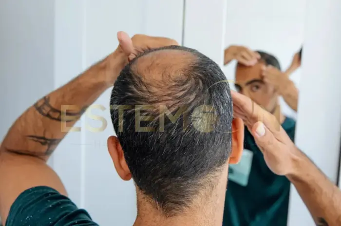 Uses, Side Effects and Benefits of Finasteride