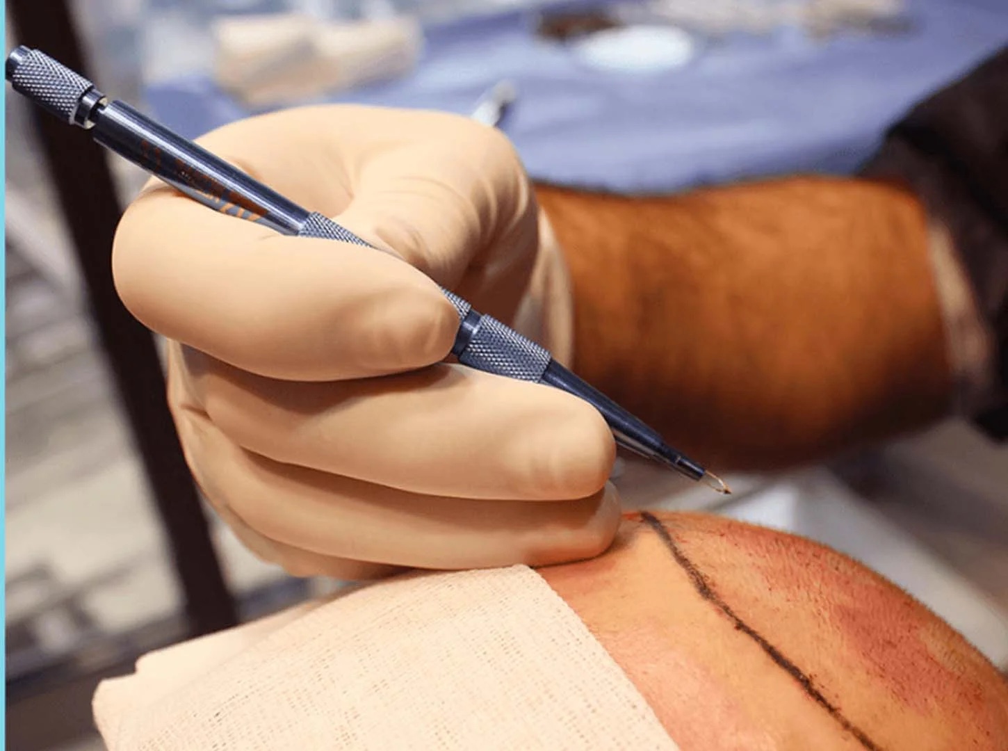 Gloved hand holding a sapphire blade above a scalp marked with a drawn hairline, opening recipient channels.