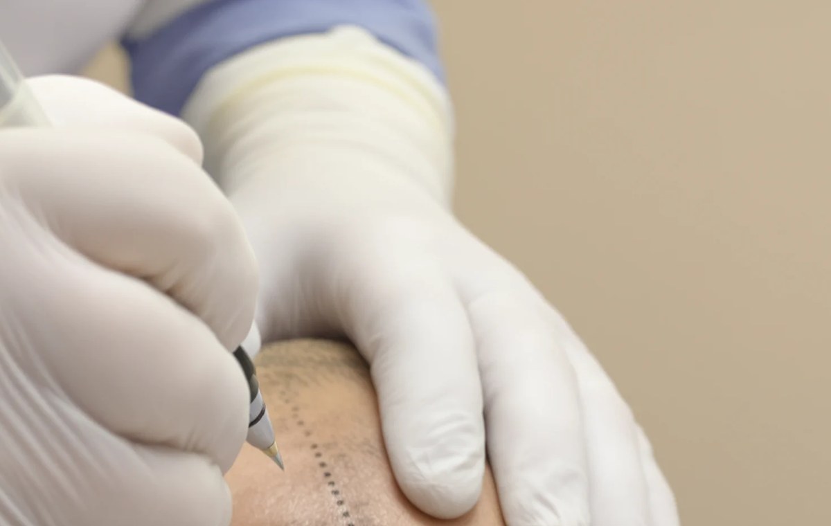 Marked hairline on the scalp before a hair transplant procedure