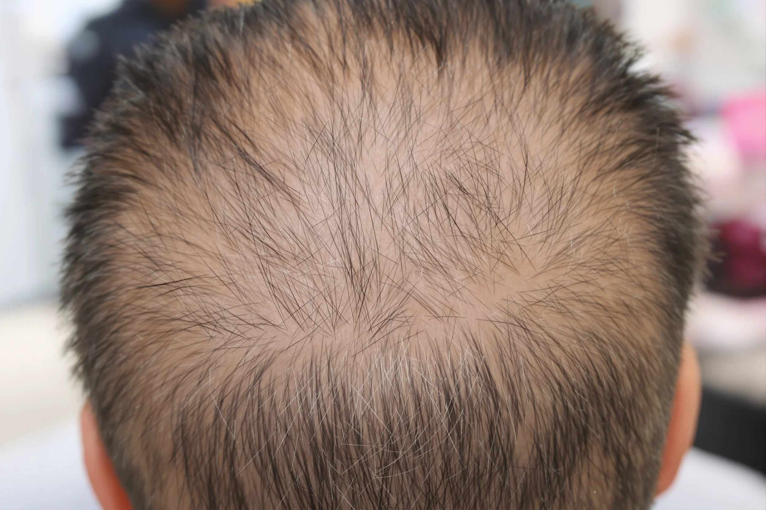 Turkey vs Local Hair Transplants: Cost & Quality