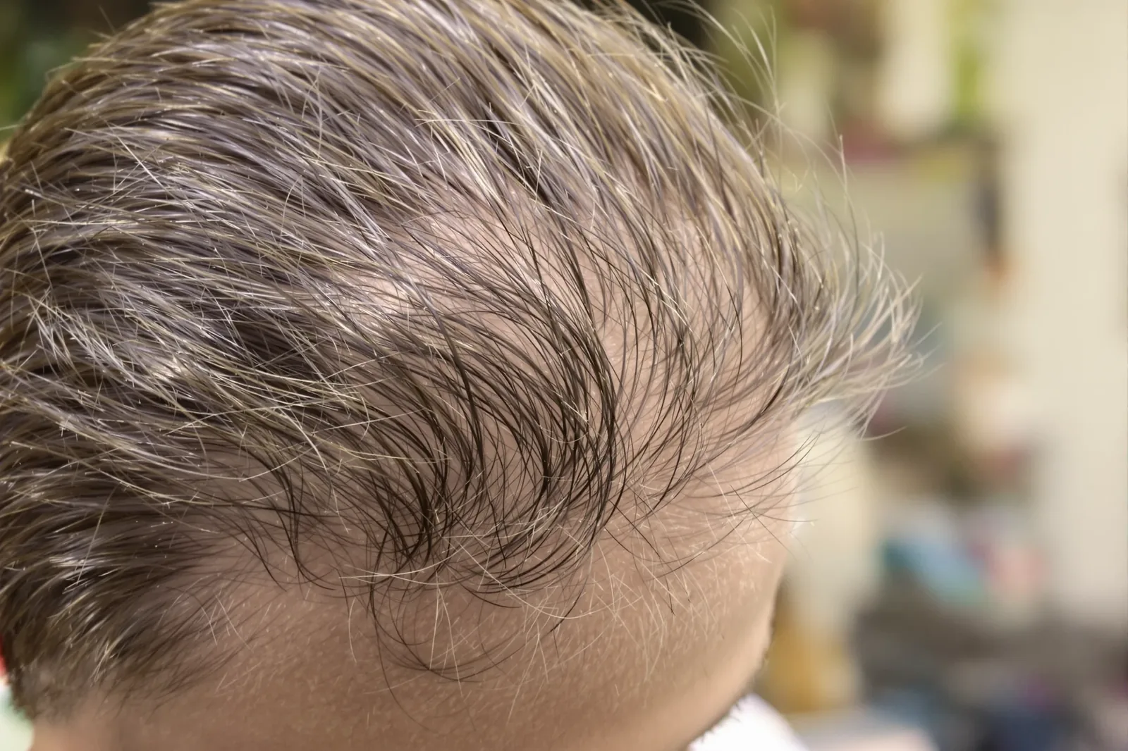 Hair Transplant Before and After: Real Results and Timeline