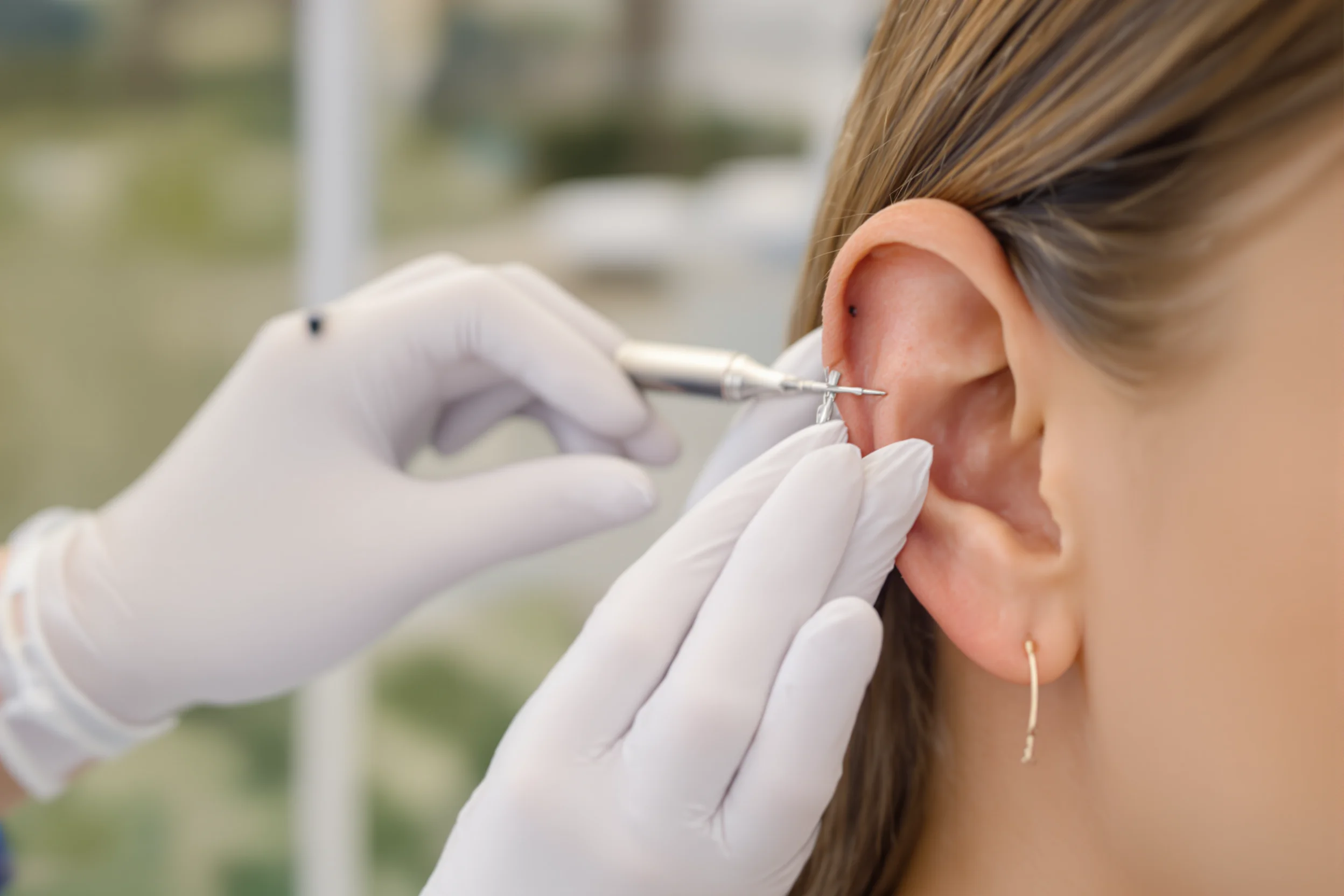 Otoplasty (Ear Reshaping): Procedure and Recovery Guide